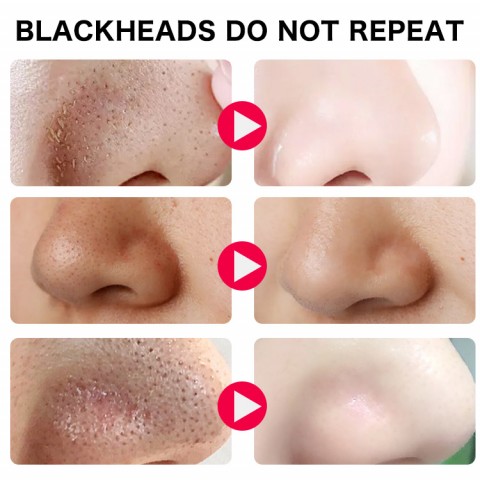 Visual Blackhead Remover
