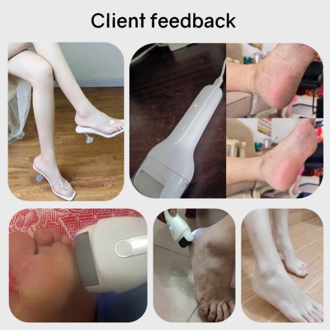 Portable electric foot callus remover